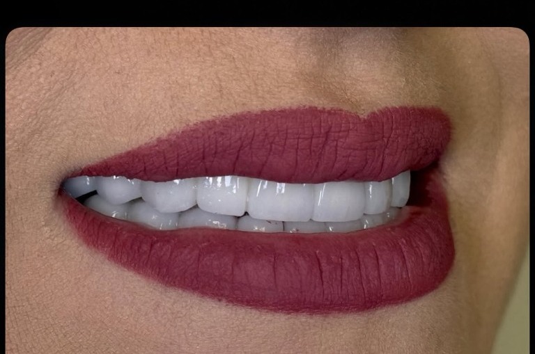 Recondiționare dentară completă — Comparație — după