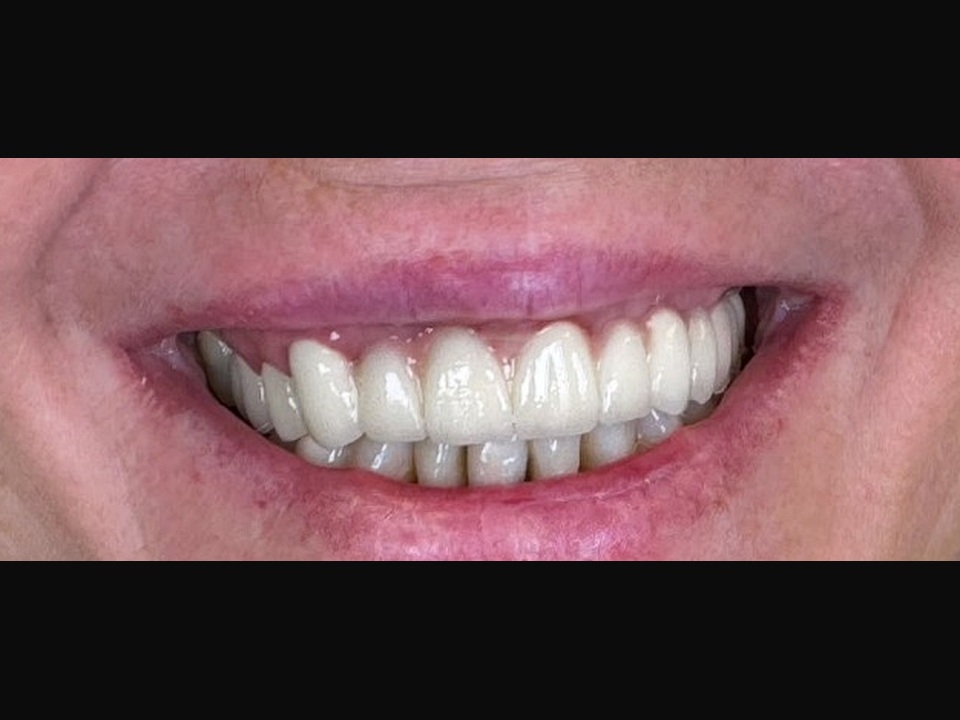 Coroane metalo-ceramice total fizionomice — Comparație — după